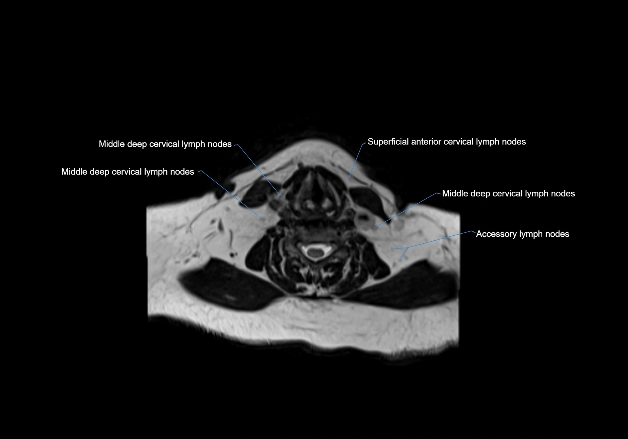 Neck axial  lymph node cross sectional MRI anatomy 3T MRI  image-img-00001-00066.webp